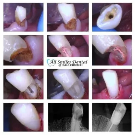 Clinical images demonstrating biomimetic dentistry techniques for conservative tooth restoration